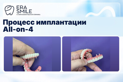 Процесс имплантации All-on-4