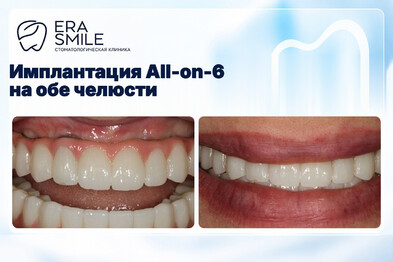 Имплантация All-on-6 на обе челюсти