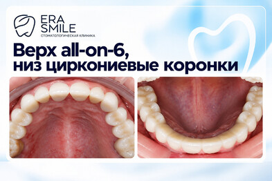 Комбинированная работа: верх all-on-6, низ циркониевые коронки на своих зубах