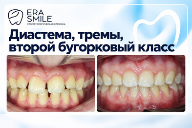Диастема, тремы, второй бугорковый класс