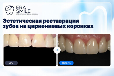 Эстетическая реставрация зубов на циркониевых коронках