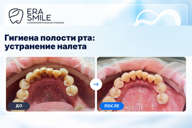 Гигиена полости рта: устранение налета