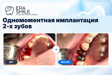 Одномоментная имплантация 2-х зубов