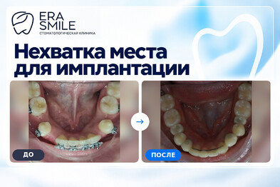 Нехватка места для имплантации и грамотного протезирования