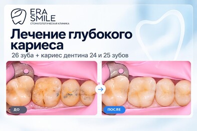 Лечение глубокого кариеса 26 зуба, кариес дентина 24 и 25 зубов
