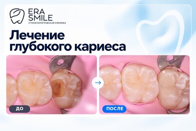 Лечение глубокого кариеса