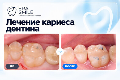 Лечение кариеса дентина