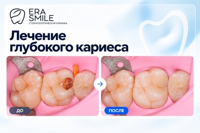 Лечение глубокого кариеса