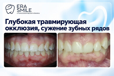 Глубокая травмирующая окклюзия, сужение зубных рядов