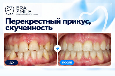 Перекрестный прикус, скученность