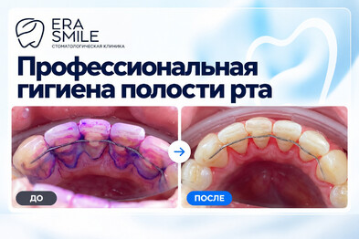 Профессиональная гигиена полости рта