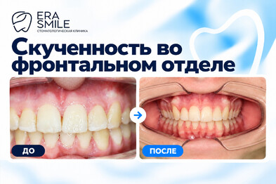Скученность во фронтальном отделе, 2 класс справа, 1 класс слева