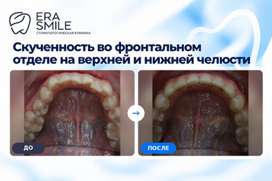 Скученность во фронтальном отделе на верхней и нижней челюсти, обратное перекрытие в области бокового резца