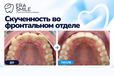 Скученность во фронтальном отделе