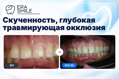 Скученность, глубокая травмирующая окклюзия