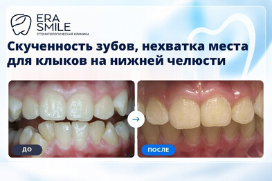 Скученность зубов, нехватка места для клыков на нижней челюсти, сужение зубных рядов