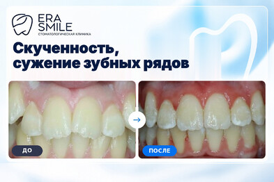 Скученность, сужение зубных рядов, супроположение клыков