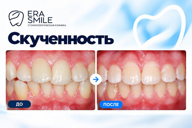 Скученность