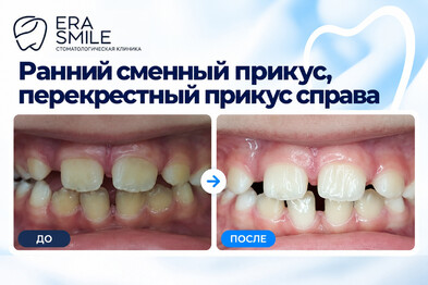 Ранний сменный прикус, перекрестный прикус справа, аппарат McNamara