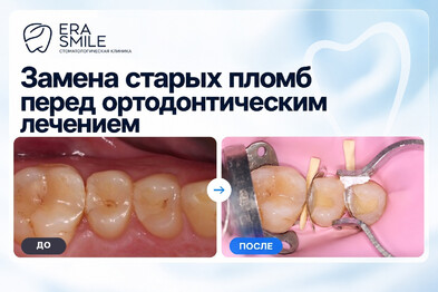 Замена старых пломб перед ортодонтическим лечением